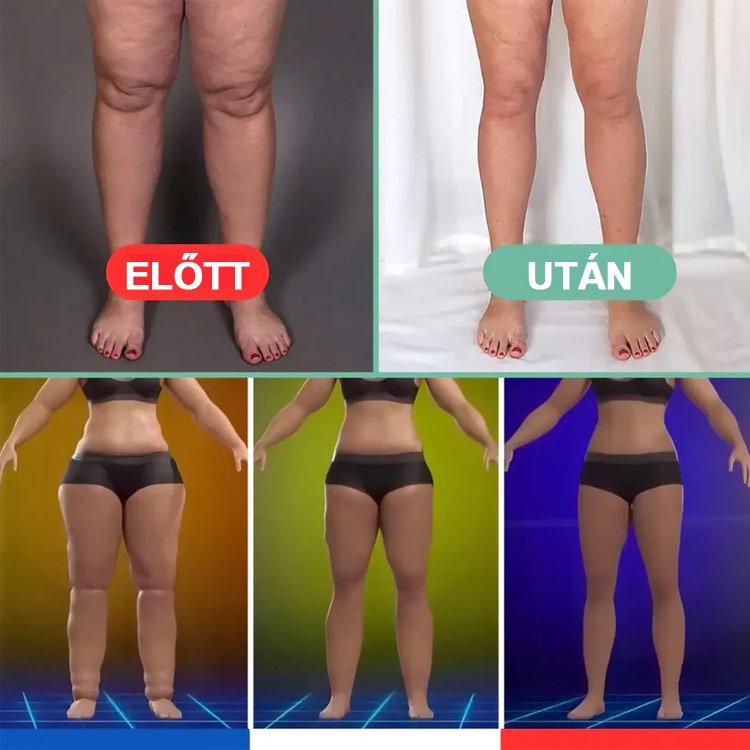 🔥💆Elektronikus limfavizeletű és cellulitisellenes masszírozó eszköz