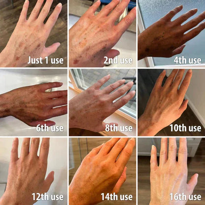 ✨Gyors Sötét Folteltávolító - AQA™ Melanin Korrekciós Arcszérum (🔥Utolsó Napi Akció 60% KEDVEZMÉNY)