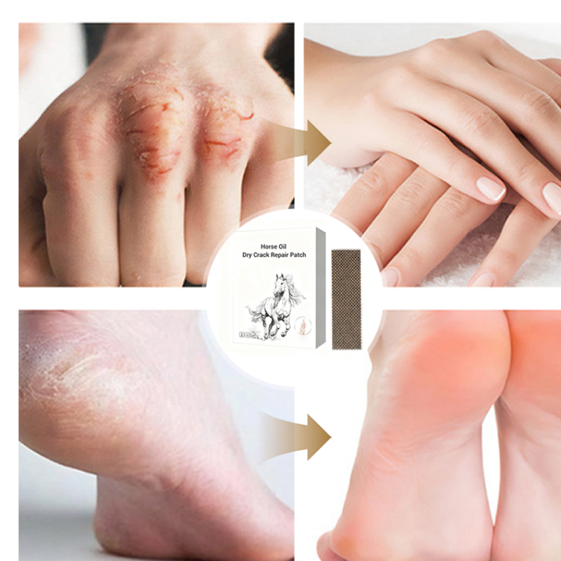 🌿 Lóolajos kéz- és lábápoló tapasz 🩹 Intenzív hidratálás száraz, repedezett bőrre, hosszan tartó enyhülés 🛡️🦟